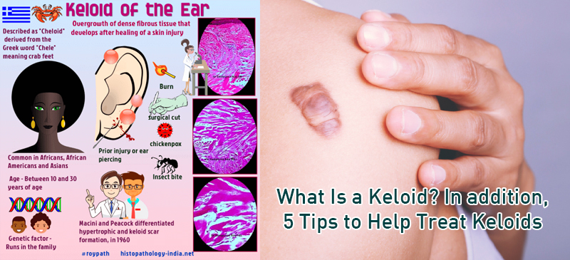 what is a keloid in addition 5 tips to help treat keloids cokbilenler com